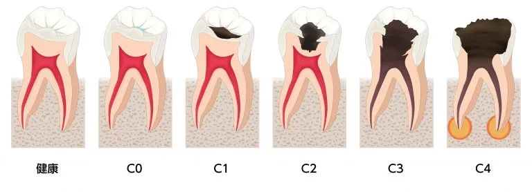虫歯の進行状態と治療